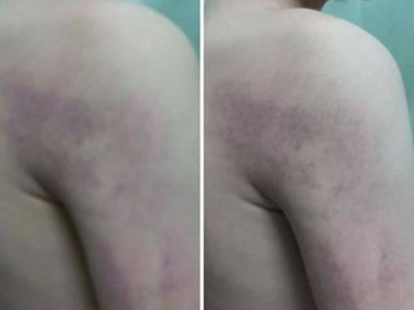 Hà Nội: Học sinh lớp 1 bị cô giáo chủ nhiệm đánh thâm tím người