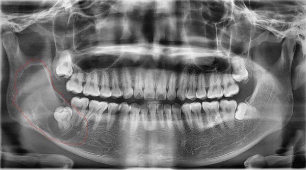 Thanh niên Hà Nội tưởng mọc răng khôn, bác sĩ lôi ra ‘thủ phạm’ trong miệng