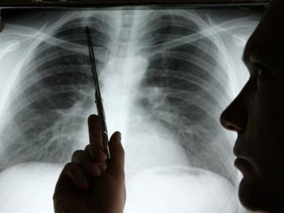 Gen liên kết có nguy cơ dẫn đến ung thư phổi ở những người không hút thuốc