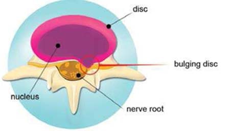 Điều trị đau cột sống cổ và lưng bằng phương pháp Nucleoplasty