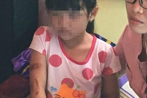 Vụ bé gái nghi bị bạo hành ở Kiên Giang: Cha và mẹ kế lý giải vết thương do... bỏng