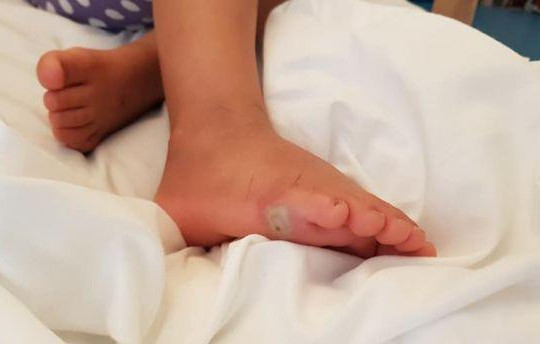 Chân trần thử giày mới, bé gái 4 tuổi bị nhiễm trùng máu suýt chết