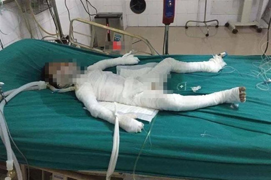 Hà Nội: Bé trai 6 tuổi bị bố dượng tẩm xăng đốt bỏng 98% đã qua đời
