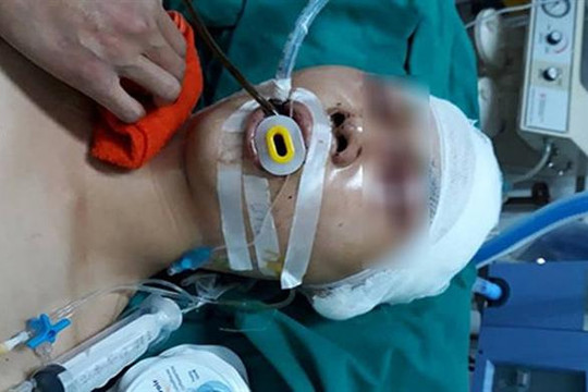 Hà Nội: Nam sinh cấp ba bị đánh chấn thương sọ não ở Long Biên
