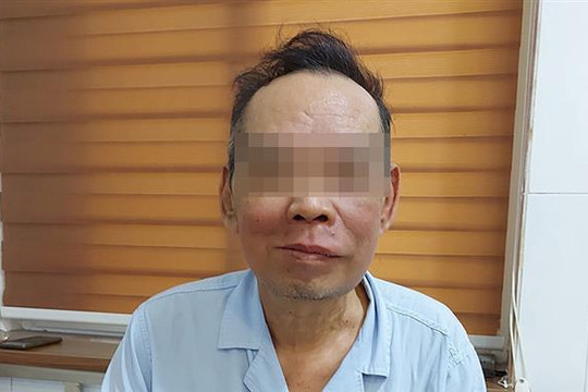 Trì hoãn điều trị vì Covid-19, người đàn ông bị khối u làm biến dạng khuôn mặt