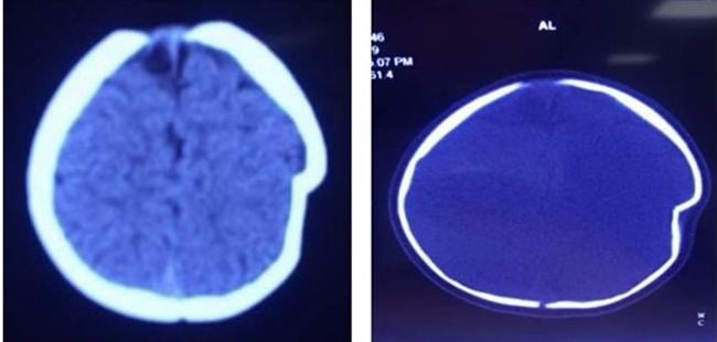 Ngã xe tập đi, bé 8 tháng tuổi bị lún sọ não