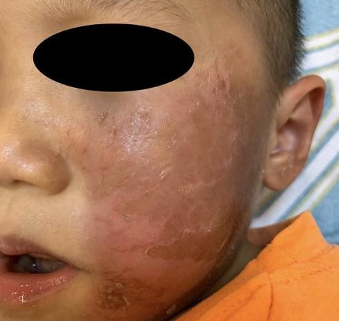 Hóa trang Halloween, bé 4 tuổi bỏng rộp da mặt và khuyến cáo của bác sĩ chuyên khoa