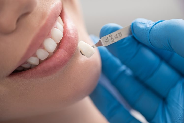 Răng sứ có mấy loại, ưu và nhược điểm của răng sứ?