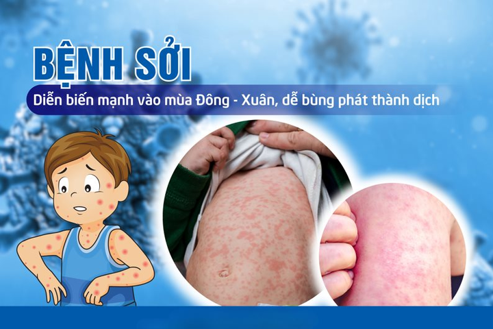 Thủ tướng Chính phủ ban hành công điện về tăng cường công tác phòng, chống bệnh sởi