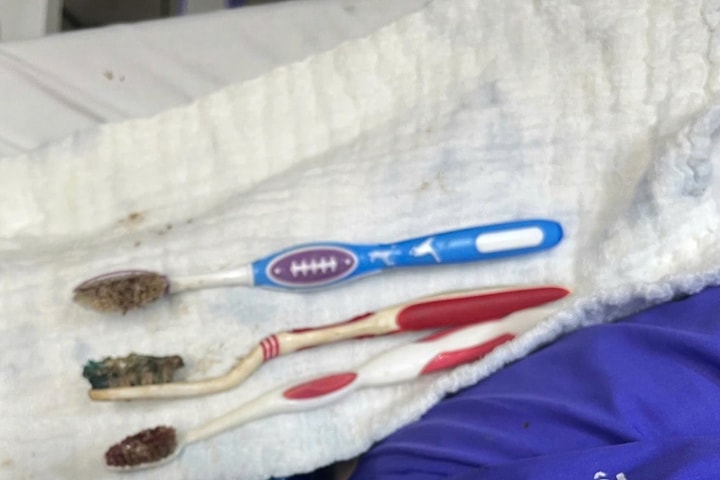 Nội soi cứu bệnh nhân tâm thần tự nuốt 3 bàn chải đánh răng