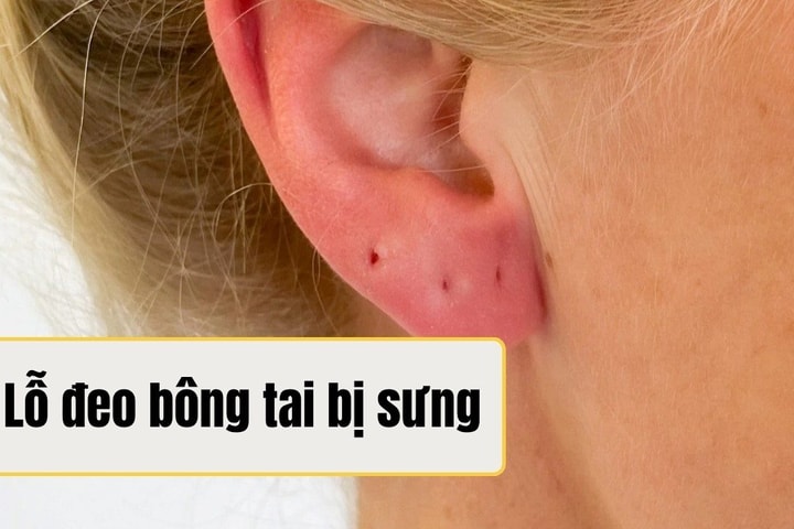 Lỗ đeo bông tai bị sưng: Nguyên nhân và cách xử lý tại nhà